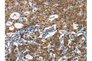The image on the left is immunohistochemistry of paraffin-embedded Human gastic cancer tissue using ABIN7190434(DCC Antibody) at dilution 1/70, on the right is treated with synthetic peptide. (DCC 抗体)