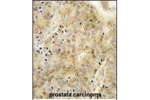 Formalin-fixed and paraffin-embedded human prostata carcinoma tissue reacted with EZH1 Antibody (Center) (ABIN389082 and ABIN2839279) , which was peroxidase-conjugated to the secondary antibody, followed by DAB staining. (EZH1 抗体  (AA 393-422))