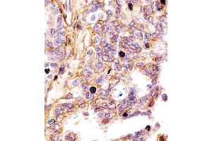 (ABIN659120 and ABIN2843760) staining CD44 in human lung adenocarcinoma tissue sections by Immunohistochemistry (IHC-P - paraformaldehyde-fixed, paraffin-embedded sections). (CD44 抗体)