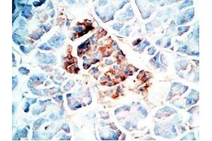 Human pancreas cancer tissue was stained by Rabbit Anti-Oxyntomodulin (H,M,R) Antibody (OXM 抗体)