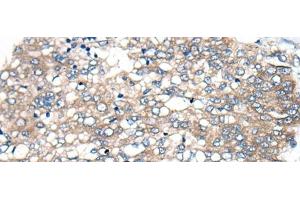 Immunohistochemistry of paraffin-embedded Human liver cancer tissue using BBS12 Polyclonal Antibody at dilution of 1:50(x200) (BBS12 抗体)