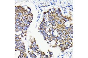 Immunohistochemistry of paraffin-embedded human lung cancer using TTC11/FIS1 antibody (ABIN7267209) at dilution of 1:100 (40x lens).