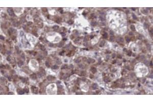 ABIN6273919 at 1/100 staining Human liver cancer tissue by IHC-P. (F4/80 抗体  (C-Term))
