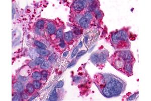 Anti-GPR4 antibody IHC of human Lung, Adenocarcinoma. (GPR4 抗体  (Extracellular Domain))