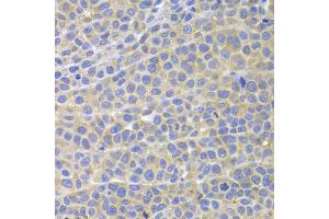Immunohistochemistry of paraffin-embedded mouse cancer using STAT4 antibody at dilution of 1:100 (x400 lens). (STAT4 抗体)