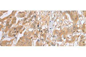 Immunohistochemistry of paraffin-embedded Human breast cancer tissue using MOB4 Polyclonal Antibody at dilution of 1:25(x200) (MOBKL3 抗体)