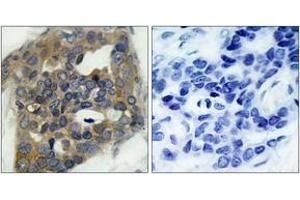 Immunohistochemistry analysis of paraffin-embedded human breast carcinoma, using ASK1 (Phospho-Ser966) Antibody. (ASK1 抗体  (pSer966))