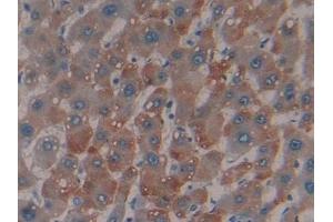 Detection of MBL in Human Liver cancer Tissue using Polyclonal Antibody to Mannose Binding Lectin (MBL) (MBL2 抗体  (AA 130-248))