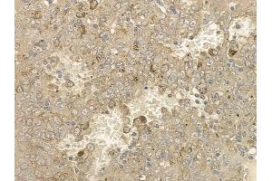 ABIN6256612 and ABIN6267176 at 1/100 staining human melanoma by IHC-P. (INPP5D 抗体  (pTyr1020, pTyr1022))