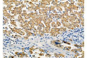 ABIN6259881 and ABIN6277303 at 1/100 staining Human liver cancer and adjacent normal tissues by IHC-P. (ALDH4A1 抗体  (C-Term))