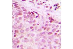 Immunohistochemical analysis of Separase (pS801) staining in human breast cancer formalin fixed paraffin embedded tissue section. (Separase 抗体  (pSer801))