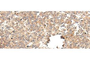 Immunohistochemistry of paraffin-embedded Human esophagus cancer tissue using CACNG5 Polyclonal Antibody at dilution of 1:50(x200) (CACNG5 抗体)