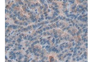 DAB staining on IHC-P; Samples: Human Thyroid cancer Tissue (Cathepsin D 抗体  (AA 169-408))