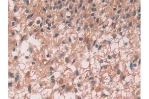 Detection of IL12A in Human Glioma Tissue using Monoclonal Antibody to Interleukin 12A (IL12A) (IL12A 抗体  (AA 23-219))