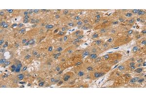 Immunohistochemistry of paraffin-embedded Human liver cancer tissue using ST18 Polyclonal Antibody at dilution 1:50 (ST18 抗体)