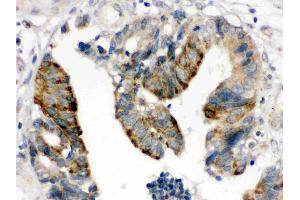 HMGB2 was detected in paraffin-embedded sections of human intestinal cancer tissues using rabbit anti- HMGB2 Antigen Affinity purified polyclonal antibody (Catalog # ) at 1 µg/mL. (HMGB2 抗体  (N-Term))