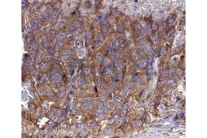 Immunohistochemistry analysis of RANTES antibody in paraffin-embedded human lung carcinoma tissue (CCL5 抗体  (Internal Region))