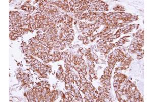 IHC-P Image Immunohistochemical analysis of paraffin-embedded human colon carcinoma, using Angiopoietin 2, antibody at 1:250 dilution. (Angiopoietin 2 抗体)