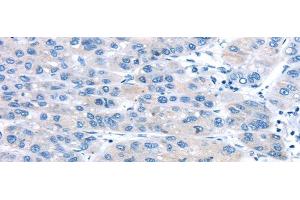 Immunohistochemistry of paraffin-embedded Human liver cancer using UCP2 Polyclonal Antibody at dilution of 1/20 (UCP2 抗体)