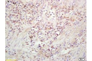 Formalin-fixed and paraffin embedded human lung carcinoma labeled with Rabbit Anti Kinesin Polyclonal Antibody, Unconjugated  at 1:200 followed by conjugation to the secondary antibody and DAB staining (Kinesin 抗体  (AA 561-660))