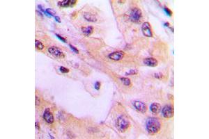 Immunohistochemical analysis of ACK1 (pY284) staining in human lung cancer formalin fixed paraffin embedded tissue section. (TNK2 抗体  (pTyr284))