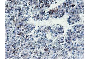 Immunohistochemical staining of paraffin-embedded Carcinoma of Human liver tissue using anti-PVRL1 mouse monoclonal antibody. (PVRL1 抗体)