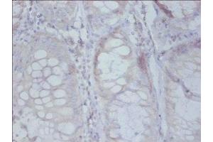 Immunohistochemistry of paraffin-embedded human colon cancer using ABIN7142508 at dilution of 1: 50 (RPS19 抗体  (AA 1-145))