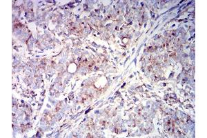 Immunohistochemical analysis of paraffin-embedded cervical cancer tissues using CD63 mouse mAb with DAB staining. (CD63 抗体  (AA 103-203))