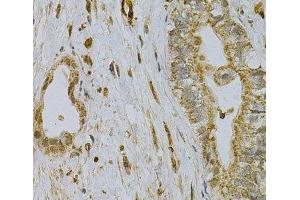 Immunohistochemistry of paraffin-embedded Human liver cancer using CDA Polyclonal Antibody at dilution of 1:100 (40x lens). (CDA 抗体)