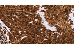 Immunohistochemistry of paraffin-embedded Human cervical cancer tissue using FANCF Polyclonal Antibody at dilution 1:60 (FANCF 抗体)