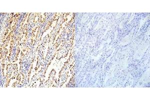Immunohistochemical analysis of paraffin- embedded human lung carcinoma tissue using LKB1 (Ab-334) antibody (E022045). (LKB1 抗体)