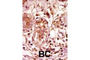 Formalin-fixed and paraffin-embedded human cancer tissue reacted with the primary antibody, which was peroxidase-conjugated to the secondary antibody, followed by AEC staining. (BUB1 抗体  (C-Term))