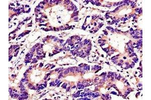 Immunohistochemistry of paraffin-embedded human colon cancer using ABIN7173671 at dilution of 1:100 (TUBA4A 抗体  (AA 20-183))