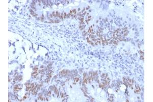 Formalin-fixed, paraffin-embedded human Colon Carcinoma stained with Retinoblastoma Recombinant Rabbit Monoclonal Antibody (RB1/2313R). (Recombinant Retinoblastoma 1 抗体)