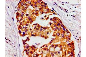 Immunohistochemistry of paraffin-embedded human breast cancer using ABIN7155948 at dilution of 1:100 (HMMR 抗体  (AA 478-653))