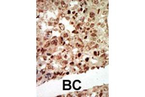 Formalin-fixed and paraffin-embedded human cancer tissue reacted with MAPK11 polyclonal antibody  , which was peroxidase-conjugated to the secondary antibody, followed by AEC staining. (MAPK11 抗体  (Internal Region))