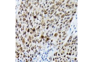 Immunohistochemistry of paraffin-embedded human lung cancer using Phospho-FOXO3A-S425 Rabbit pAb (ABIN7267246) at dilution of 1:250 (40x lens). (FOXO3 抗体  (pSer425))