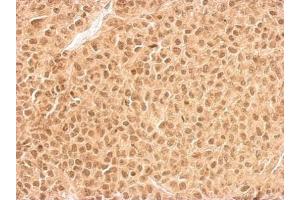 IHC-P Image RPL11 antibody detects RPL11 protein at cytosol and nucleus on HeLa xenograft by immunohistochemical analysis.