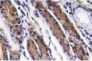 Immunohistochemistry analysis of Pepsin A Antibody in paraffin-embedded human lung carcinoma tissue. (Pepsin 抗体)