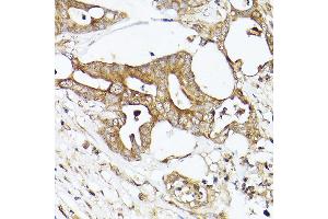 Immunohistochemistry of paraffin-embedded human colon carcinoma using  Rabbit pAb (ABIN7265370) at dilution of 1:50 (40x lens). (Acetyl-CoA Carboxylase alpha 抗体)
