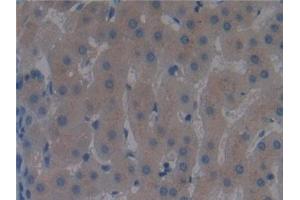 Detection of DBP in Human Liver cancer Tissue using Polyclonal Antibody to Vitamin D Binding Protein (DBP) (Vitamin D-Binding Protein 抗体  (AA 395-474))