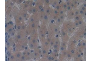 Detection of DBP in Human Liver cancer Tissue using Polyclonal Antibody to Vitamin D Binding Protein (DBP) (Vitamin D-Binding Protein 抗体  (AA 395-474))