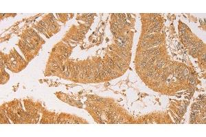 Immunohistochemistry of paraffin-embedded Human colon cancer using AK2 Polyclonal Antibody at dilution of 1:40 (Adenylate Kinase 2 抗体)