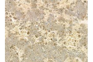 ABIN6256957 and ABIN6273762 at 1/100 staining human melanoma by IHC-P.
