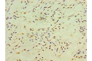 Immunohistochemistry of paraffin-embedded human breast cancer using ABIN7150305 at dilution of 1:100 (XRCC4 抗体  (AA 1-336))