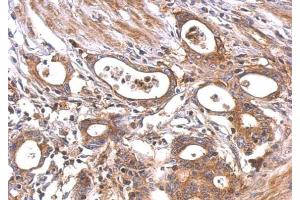 IHC-P Image MC1 Receptor antibody [C2C3], C-term detects MC1R protein at cytosol and membrane on human colon carcinoma by immunohistochemical analysis. (MC1 Receptor 抗体  (C-Term))