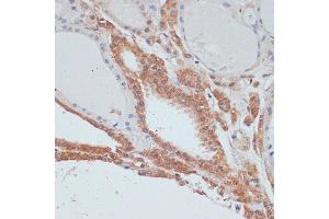 Immunohistochemistry of paraffin-embedded human thyroid cancer using MYCBP antibody (ABIN1680940, ABIN3019105, ABIN3019106 and ABIN6220717) at dilution of 1:100 (40x lens). (MYCBP 抗体  (AA 1-103))