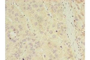 Immunohistochemistry of paraffin-embedded human liver cancer using ABIN7144179 at dilution of 1:100 (ASB11 抗体  (AA 41-315))