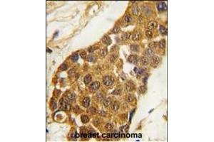 Formalin-fixed and paraffin-embedded human breast carcinoma tissue reacted with Msx2 Antibody (C-term) (ABIN1881555 and ABIN2839326) , which was peroxidase-conjugated to the secondary antibody, followed by DAB staining. (Msx2/Hox8 抗体  (C-Term))