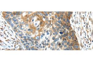 Immunohistochemistry of paraffin-embedded Human esophagus cancer using TMED4 Polyclonal Antibody at dilution of 1/45 (TMED4 抗体)